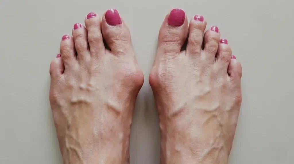 Joanete: como a cirurgia evoluiu — e por que hoje é possível tratar sem medo